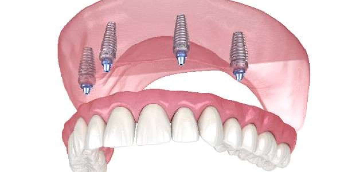 5 Key Advantages of Zirconia Implants Over Traditional Implants